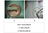 Phân lập tế bào gốc trung mô cuống rốn và hiện tượng dương tính gene CD34