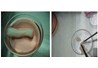Phân lập tế bào gốc trung mô cuống rốn và hiện tượng dương tính gene CD34